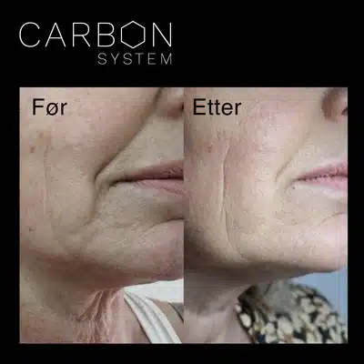 carbonpeel_sm8.webp