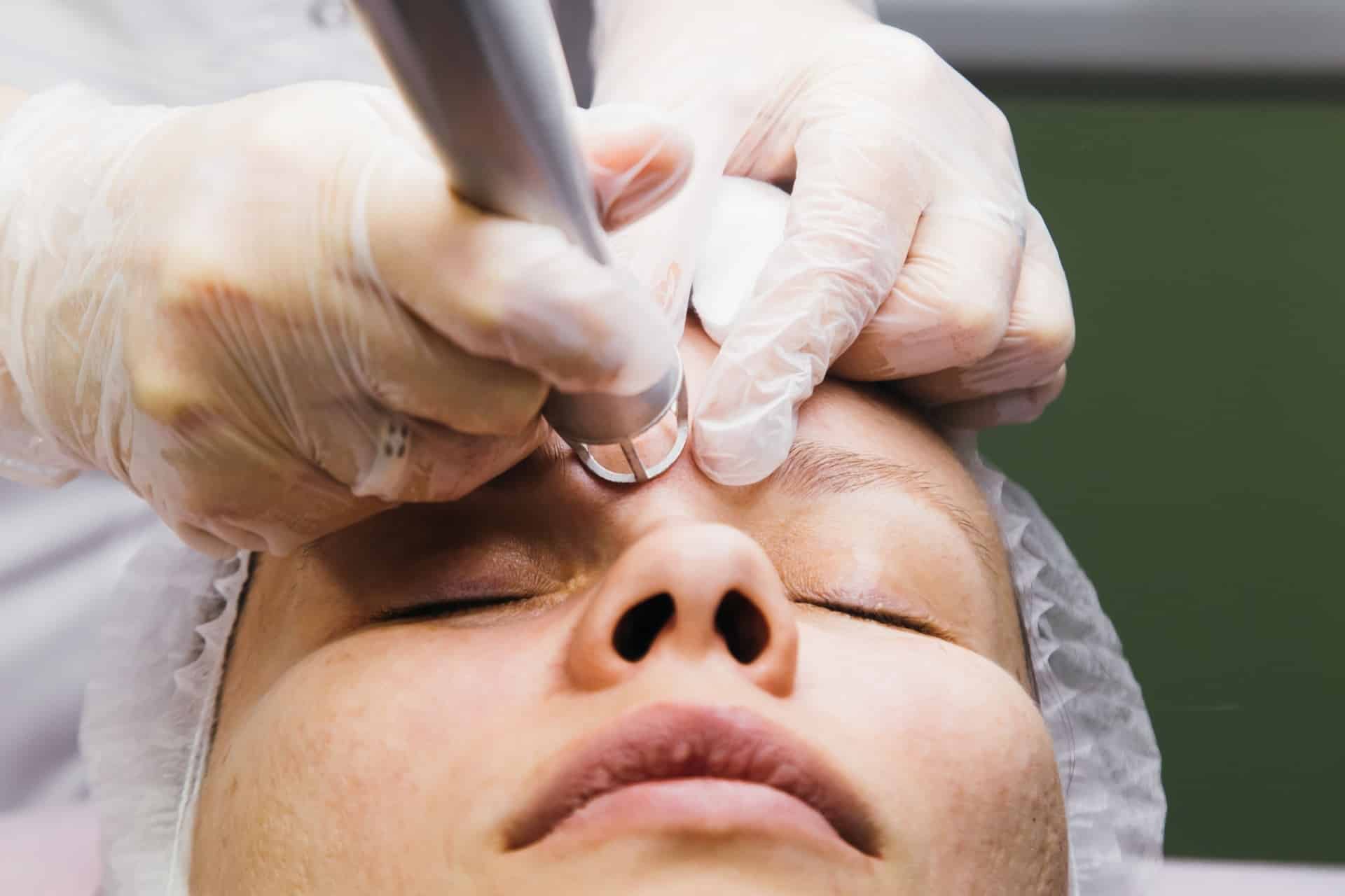 laser-pigmentering-2.jpg