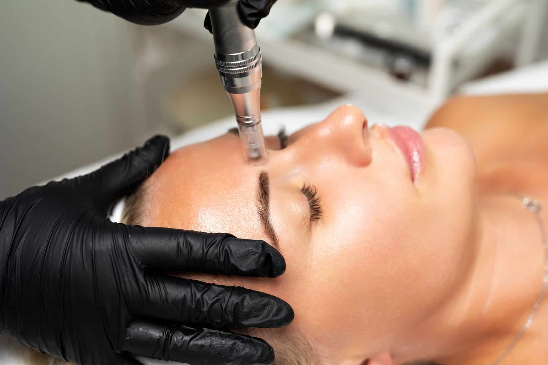 microneedling-3.jpg