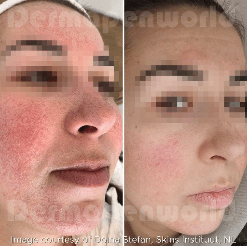 rosacea-exosomer.png
